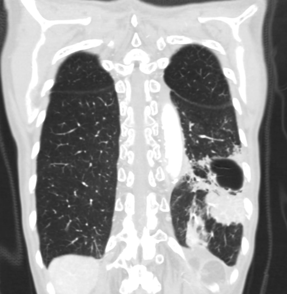 109Lu Cystic Adenocarcinoma With Lepidic Growth | Lungs