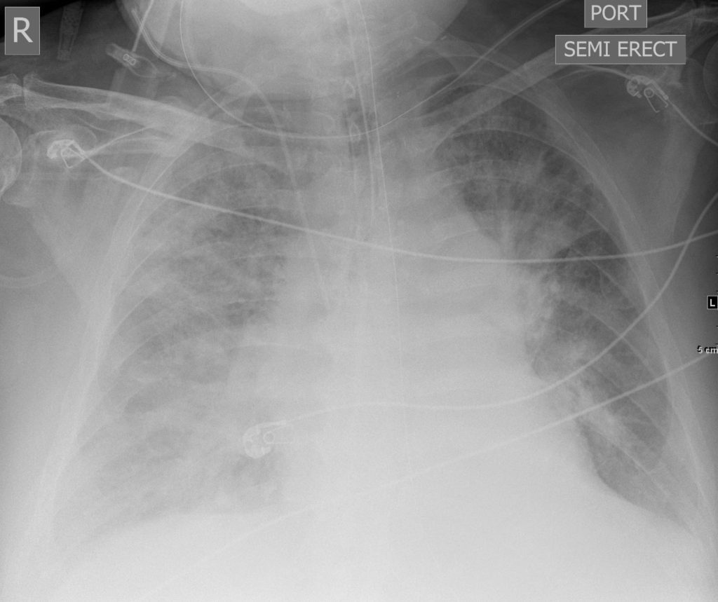 119Lu Pulmonary Edema and Intracranial Bleed | Lungs