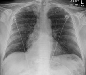 Hernias in the Chest | Lungs