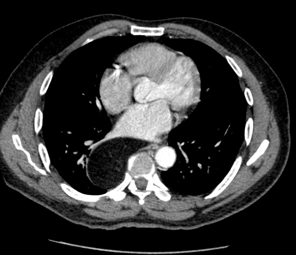 Hernias in the Chest | Lungs