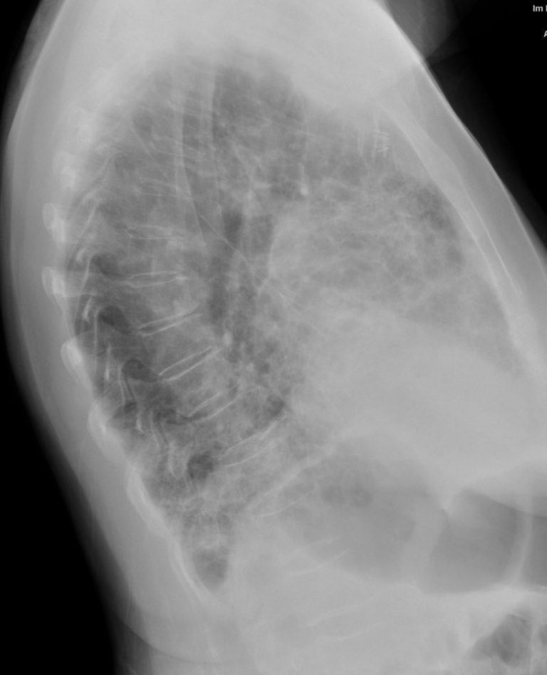 123lu Ild And Honeycomb Lung Lungs 9934