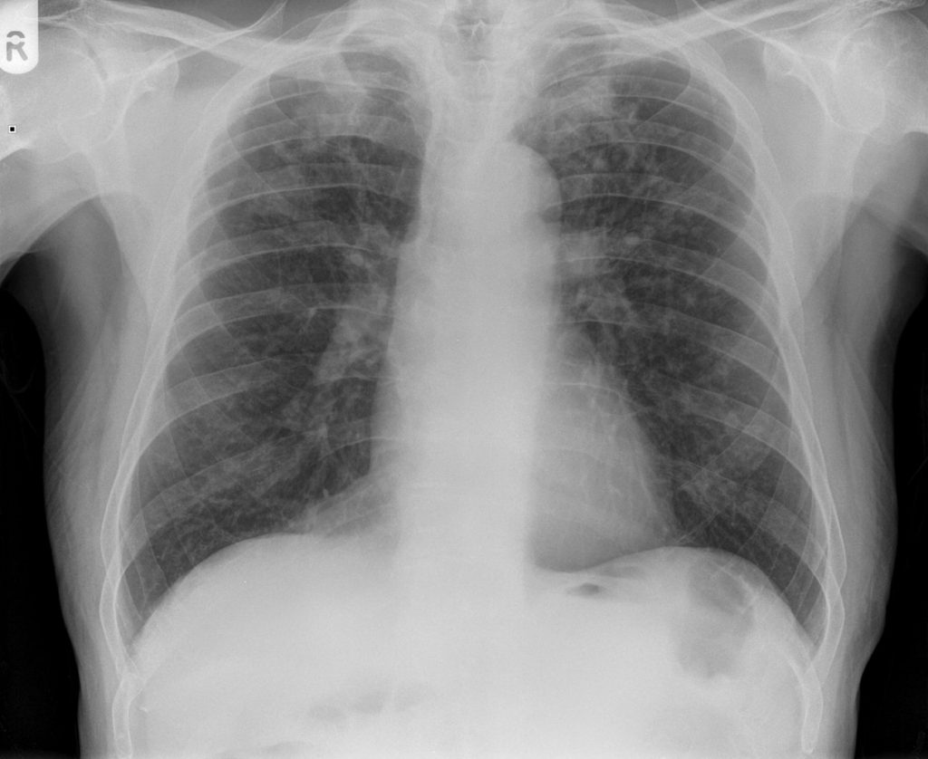 Upper Lung Zones and Silicosis | Lungs