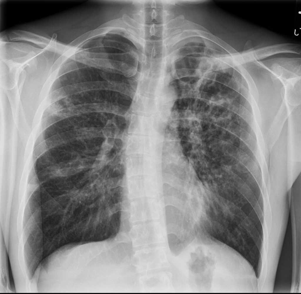 131Lu Active TB with Transbronchial Spread | Lungs