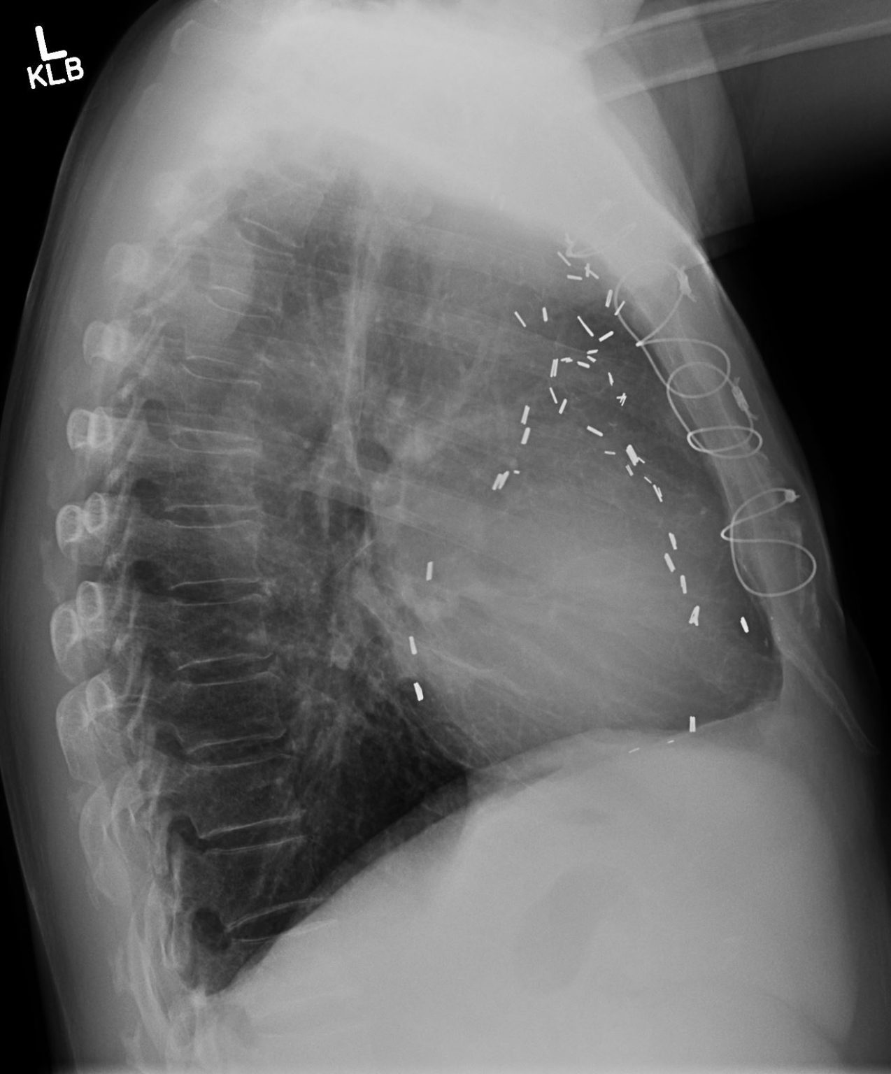 134Lu Pleural Desmoid Tumor | Lungs