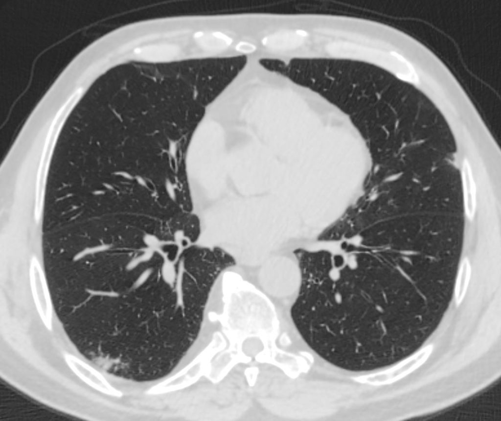 136lu Chronic Eosinophilic Pneumonia 