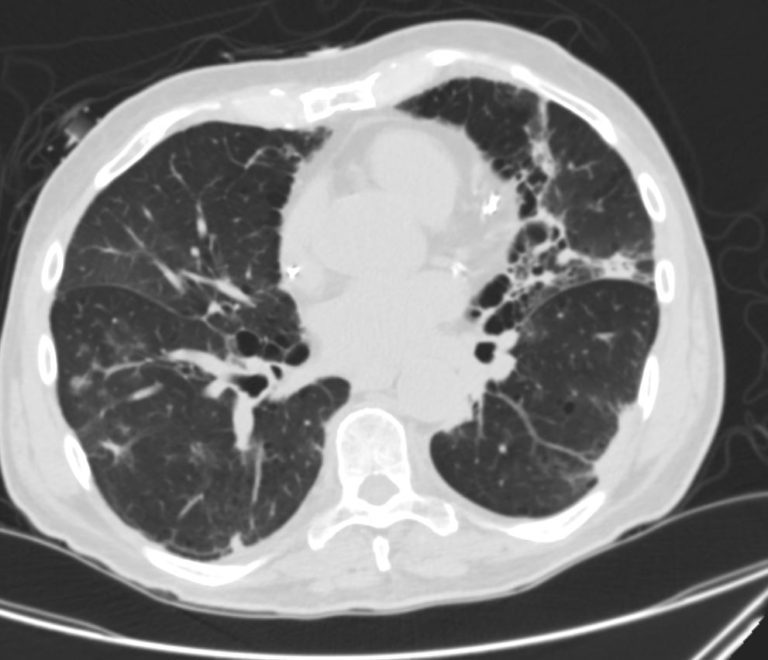 127Lu COPD Pneumonia Atypical Appearance | Lungs