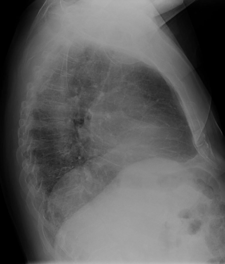 141lu Fibrotic Nsip Possible 