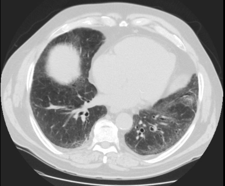 141Lu Fibrotic NSIP possible | Lungs