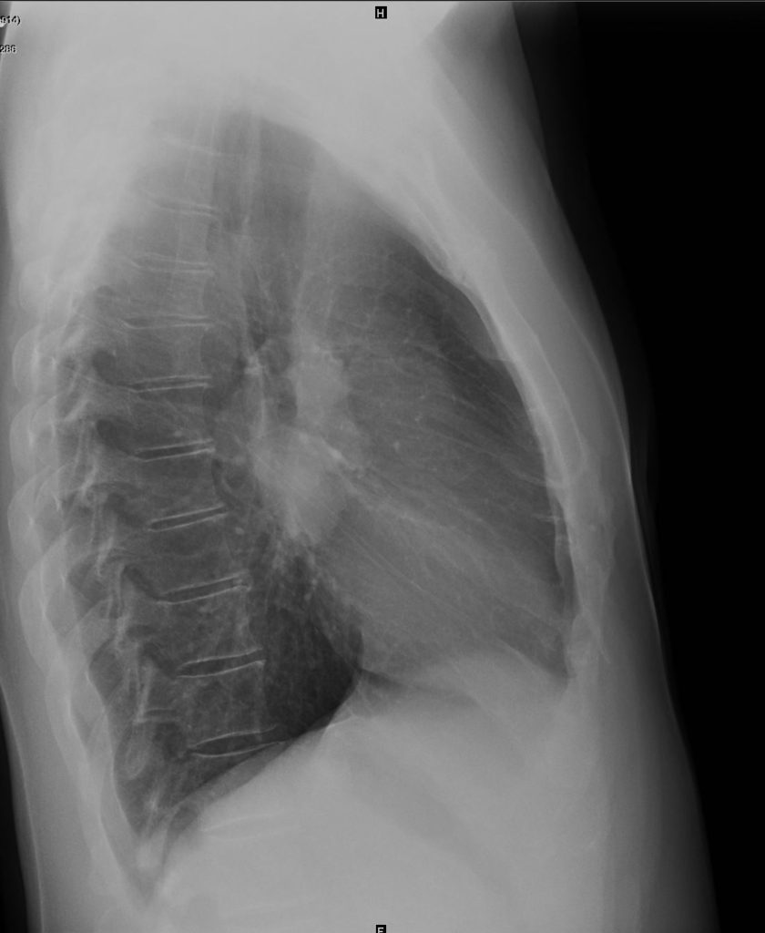 143Lu Stage 1 sarcoidosis | Lungs