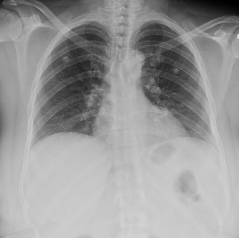 145Lu Sarcoidosis Single Lobular Nodule Air Bronchograms | Lungs