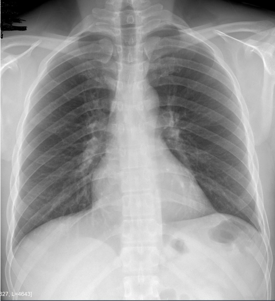 CXR Normal | Lungs