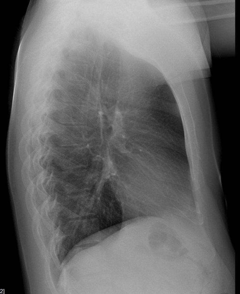 CXR Normal | Lungs