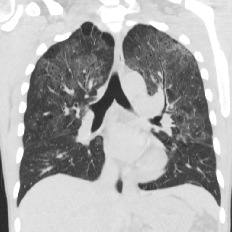 000 Pneumocystis Pneumonia | Lungs