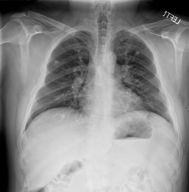 147lu Drug Toxicity Lung Disease 