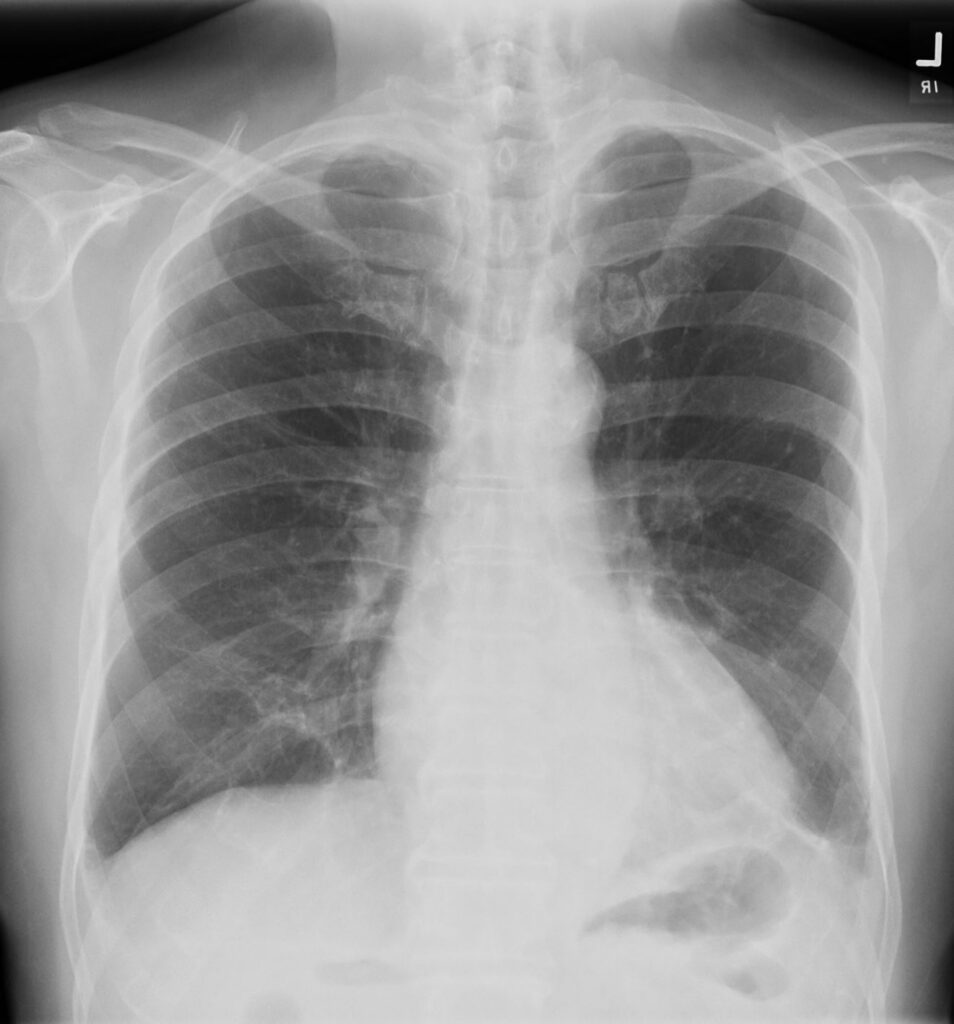 173Lu Hypersensitivity Pneumonitis (HP) | Lungs