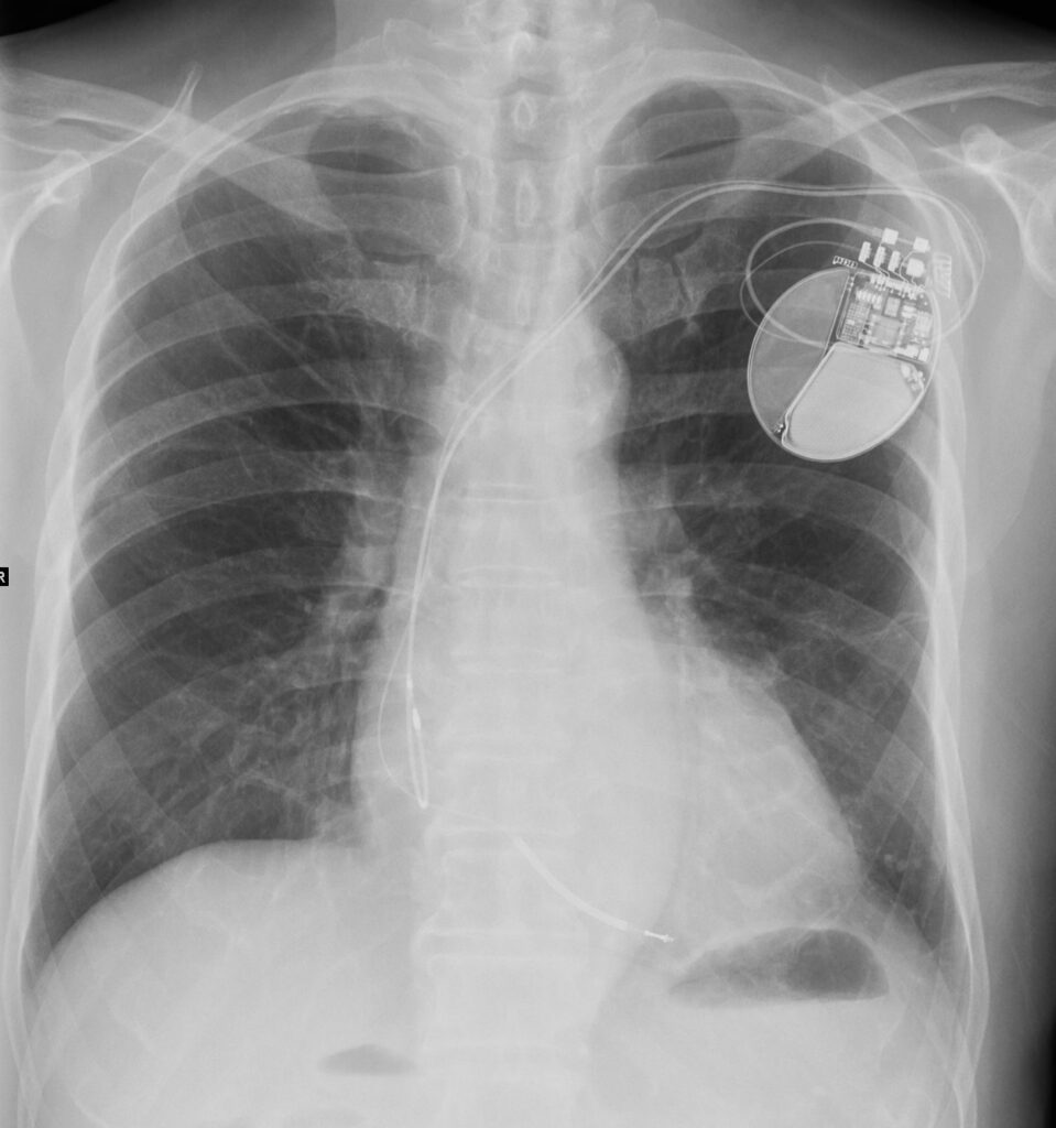 173Lu Hypersensitivity Pneumonitis (HP) | Lungs