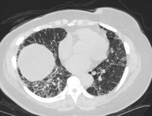 150LU Progressive ILD UIP vs Fibrotic NSIP | Lungs