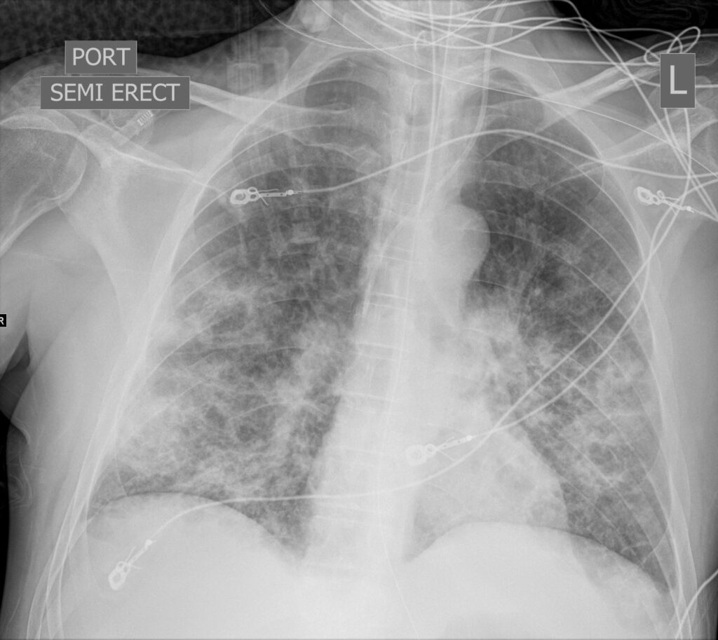 159Lu Likely Pneumocystis Pneumonia (PCP) | Lungs