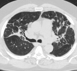 151Lu End Stage IV Sarcoidosis | Lungs