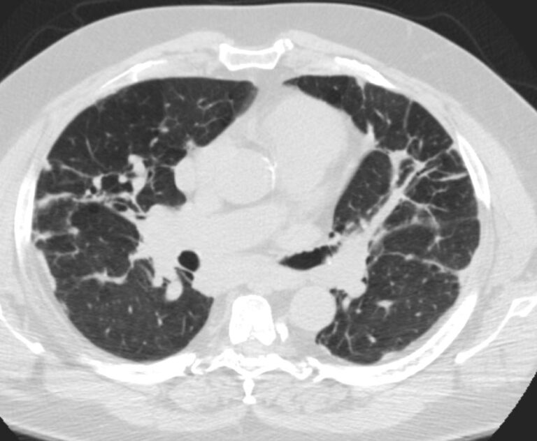 151Lu End Stage IV Sarcoidosis | Lungs