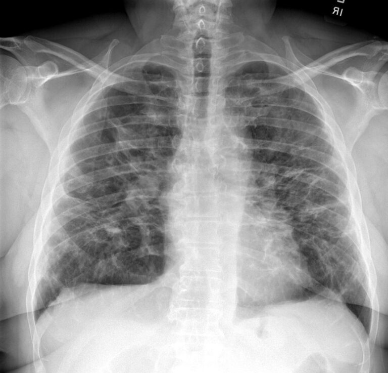 151Lu End Stage IV Sarcoidosis | Lungs