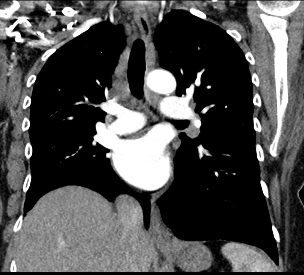 157LU Sjogren’s Basilar Cystic Lung Disease LIP vs Birt Hogg Dube | Lungs