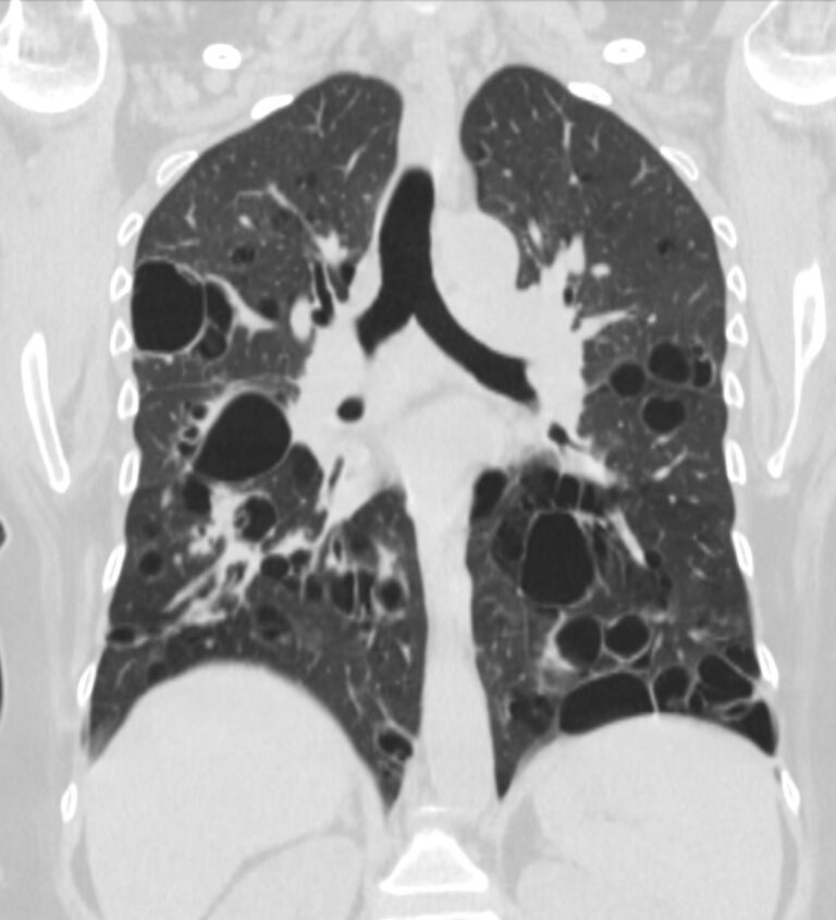 000 Cysts in the Lung | Lungs