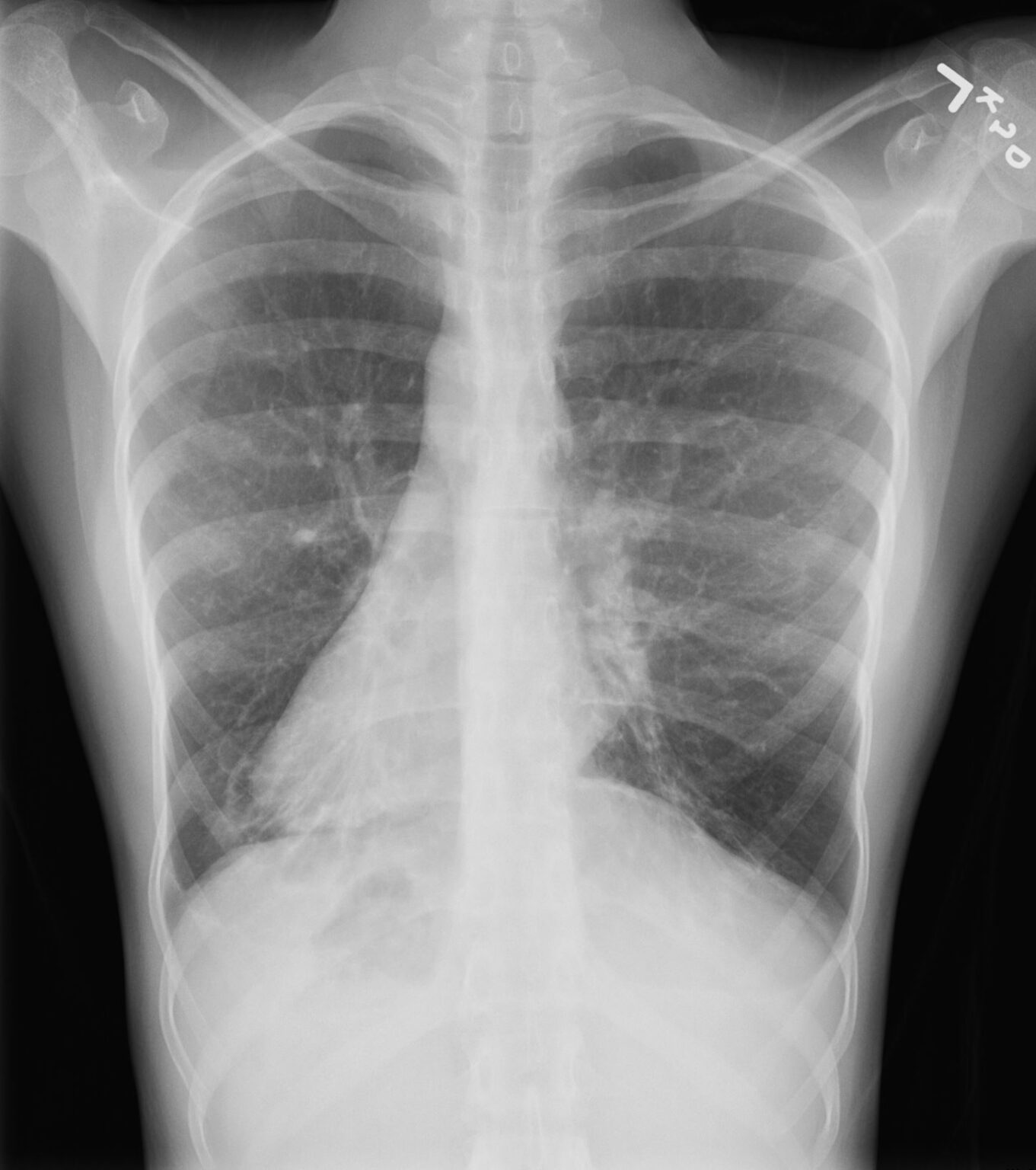 156Lu Kartagener’s Syndrome | Lungs