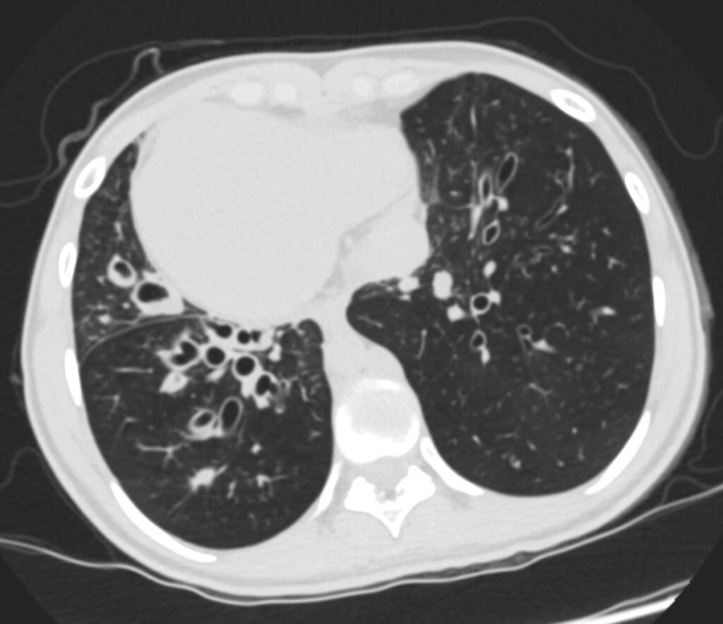 156Lu Kartagener’s Syndrome | Lungs