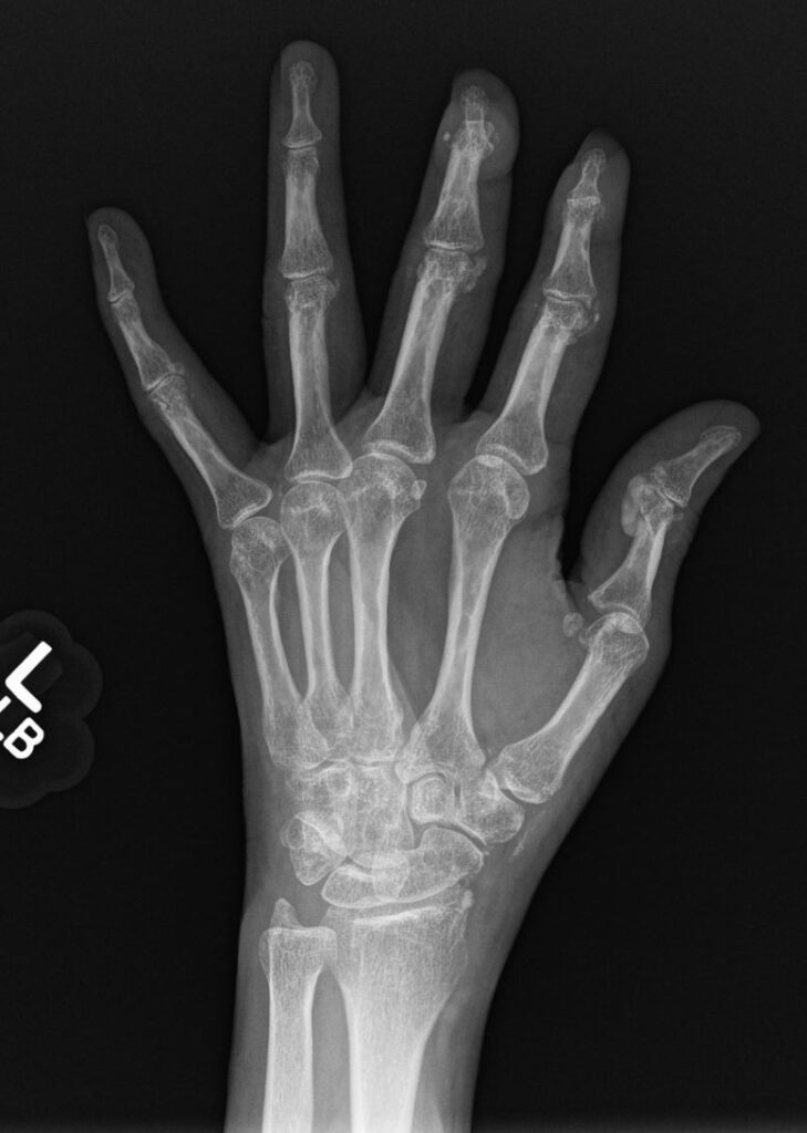 153Lu Myopathy Arthritis and Possible Scleroderma Overlap Fibrotic NSIP ...