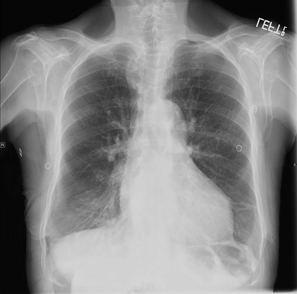 154LU Bronchiectasis | Lungs