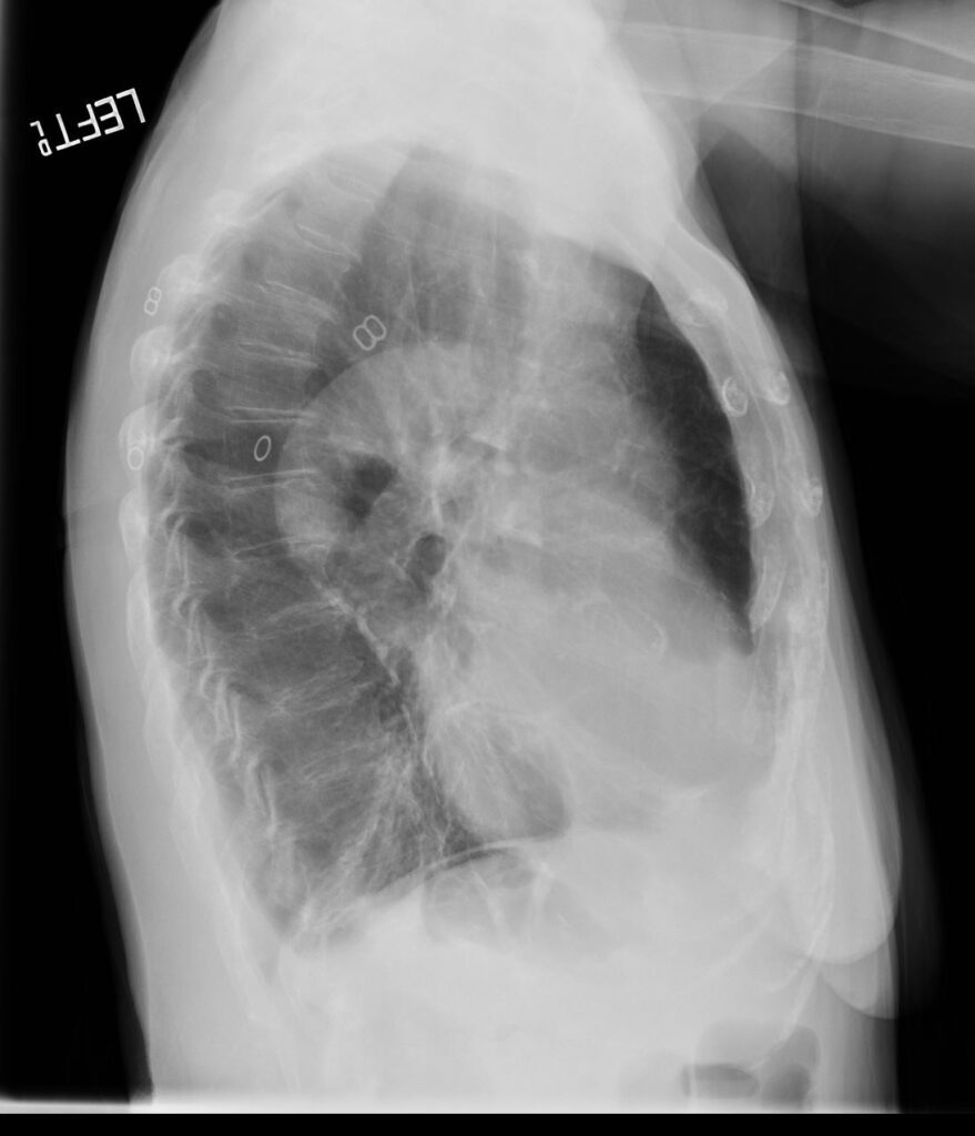 154LU Bronchiectasis | Lungs