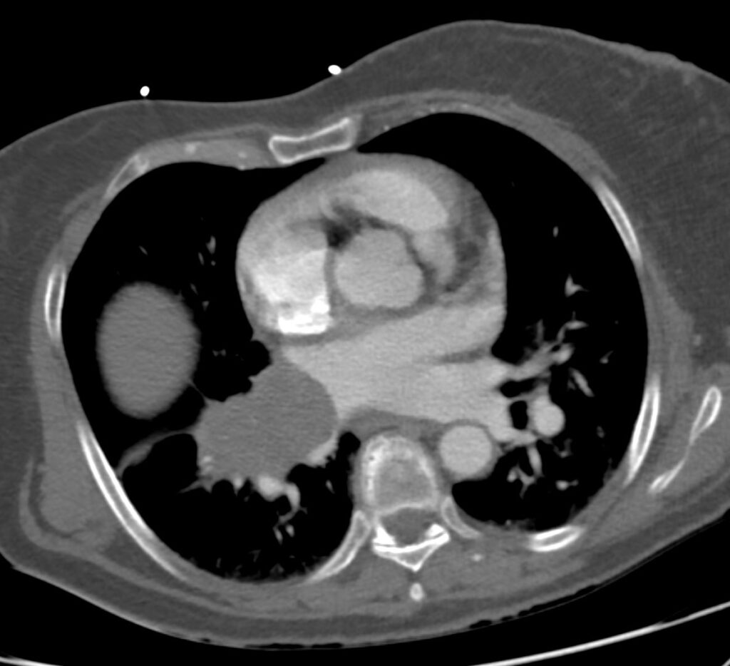 Leiomyosarcoma Metastases 