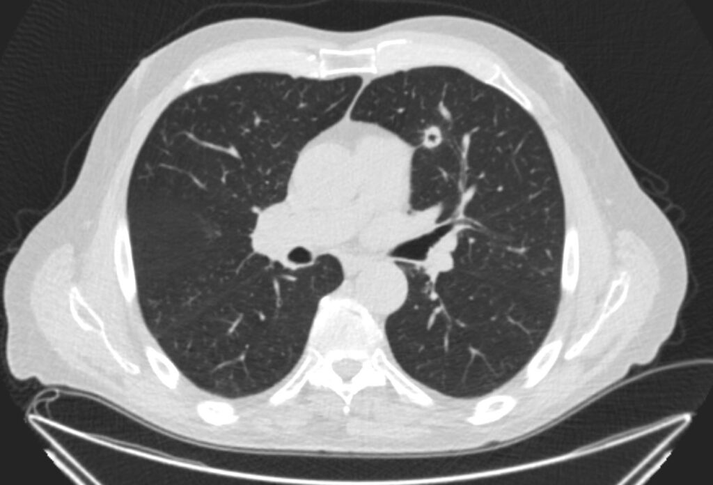 Nodules and Masses Cavitating Links on Web | Lungs