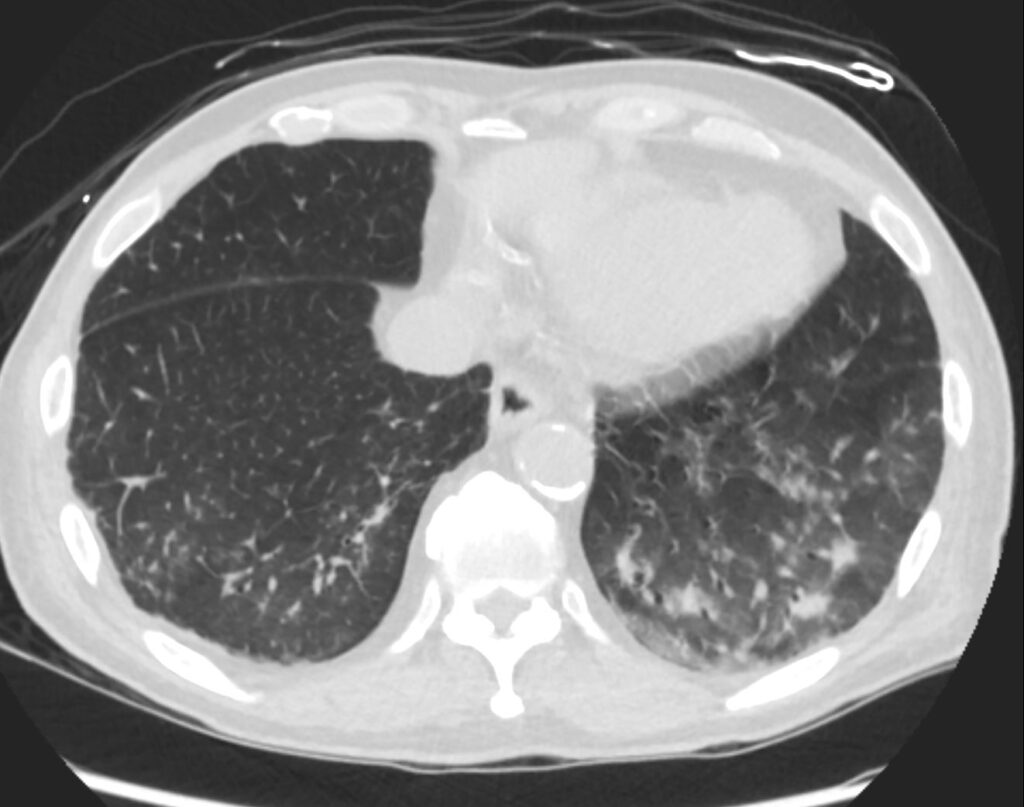 000 Tree-in-Bud sign | Lungs