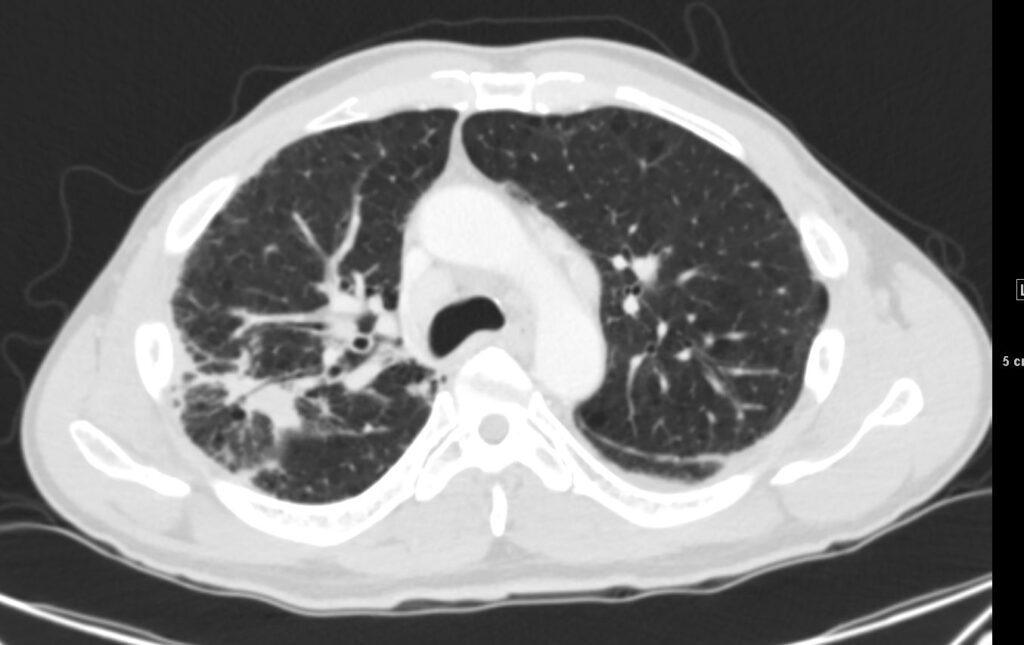 155Lu Sarcoidosis Masquerading as Lung Cancer | Lungs