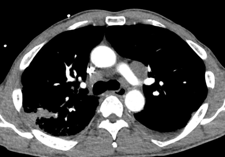 155lu Sarcoidosis Masquerading As Lung Cancer Lungs