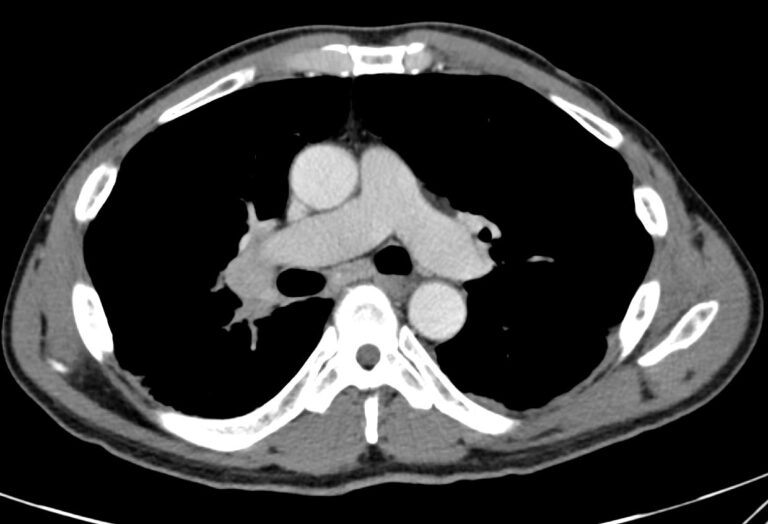 155lu Sarcoidosis Masquerading As Lung Cancer Lungs