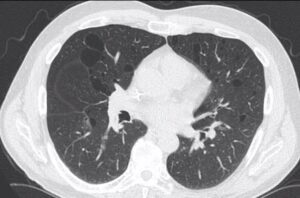 000 Birt Hogg Dube Syndrome | Lungs