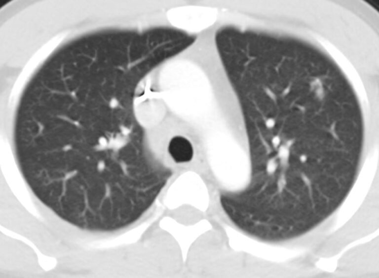 167Lu TB Lungs Liver Spleen | Lungs