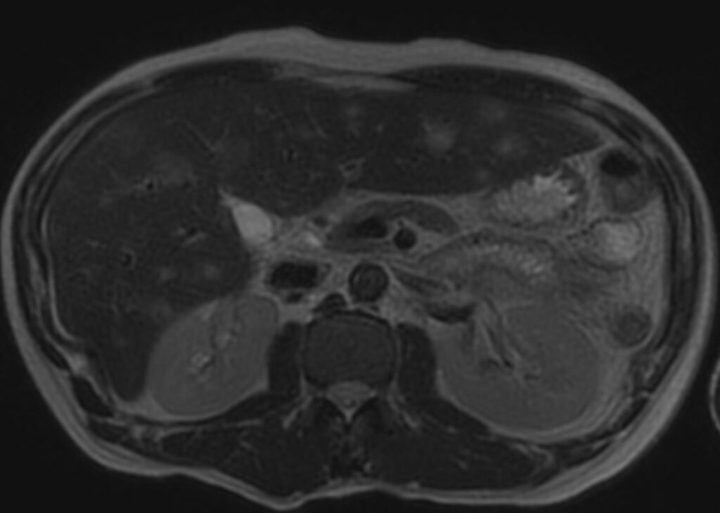 167Lu TB Lungs Liver Spleen | Lungs