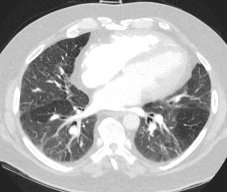 000 Mosaic Attenuation Pattern | Lungs