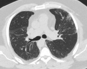 163Lu Fibrotic Hypersensitivity Pneumonitis | Lungs