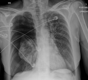 000 Tension Pneumothorax | Lungs