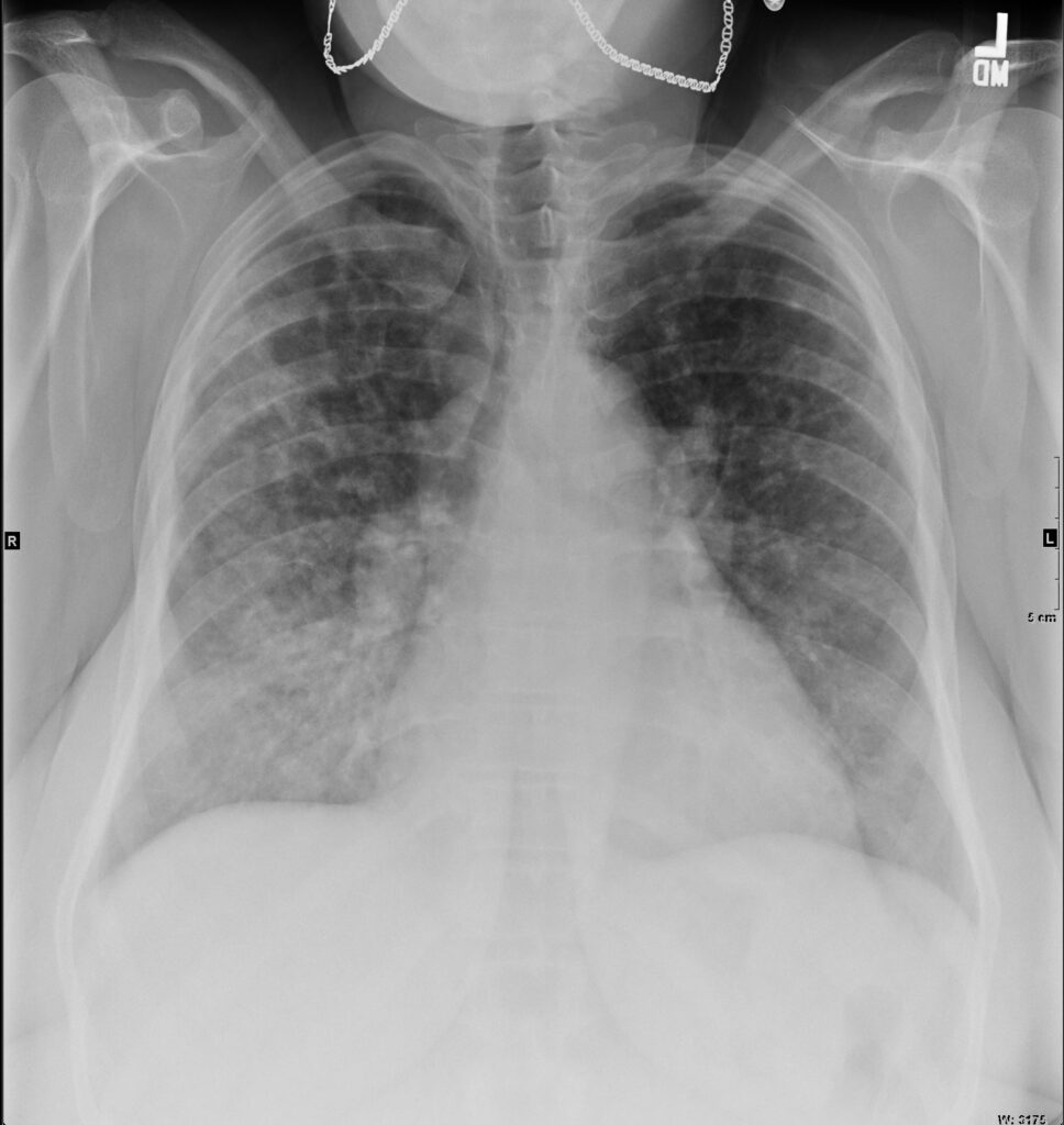 162Lu Pulmonary Langerhans Cell Histiocytosis and Treated TB | Lungs