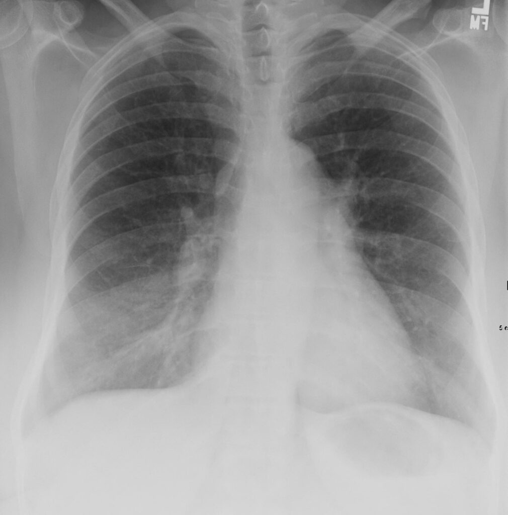 162Lu Pulmonary Langerhans Cell Histiocytosis and Treated TB | Lungs