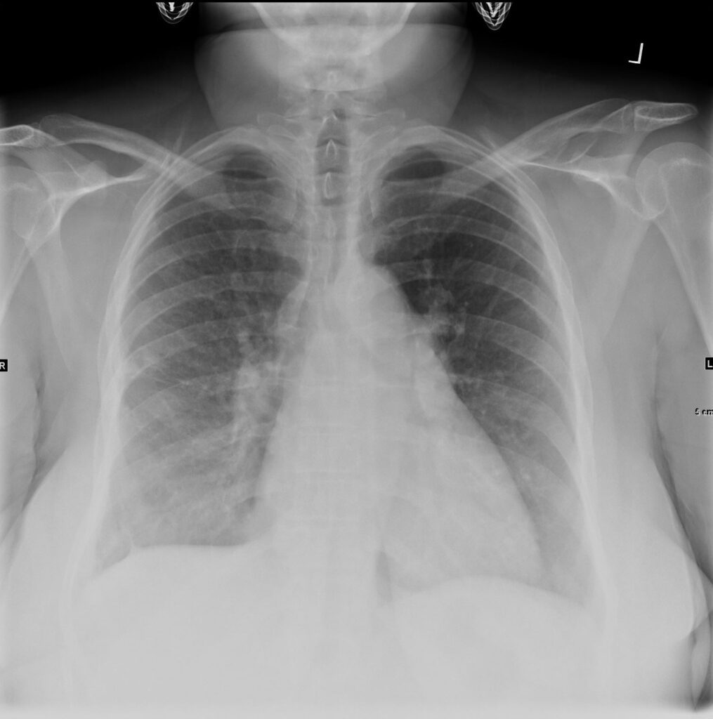 162Lu Pulmonary Langerhans Cell Histiocytosis and Treated TB | Lungs