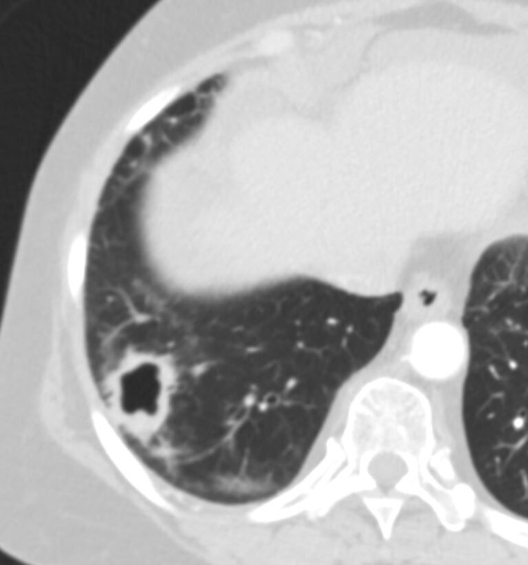 Faces Of Adenocarcinoma Of The Lung Lungs 