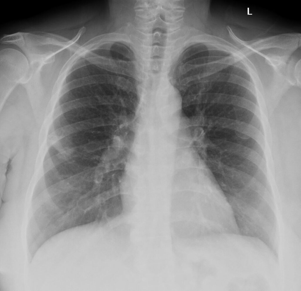 Faces of Squamous Cancer of the Lung | Lungs