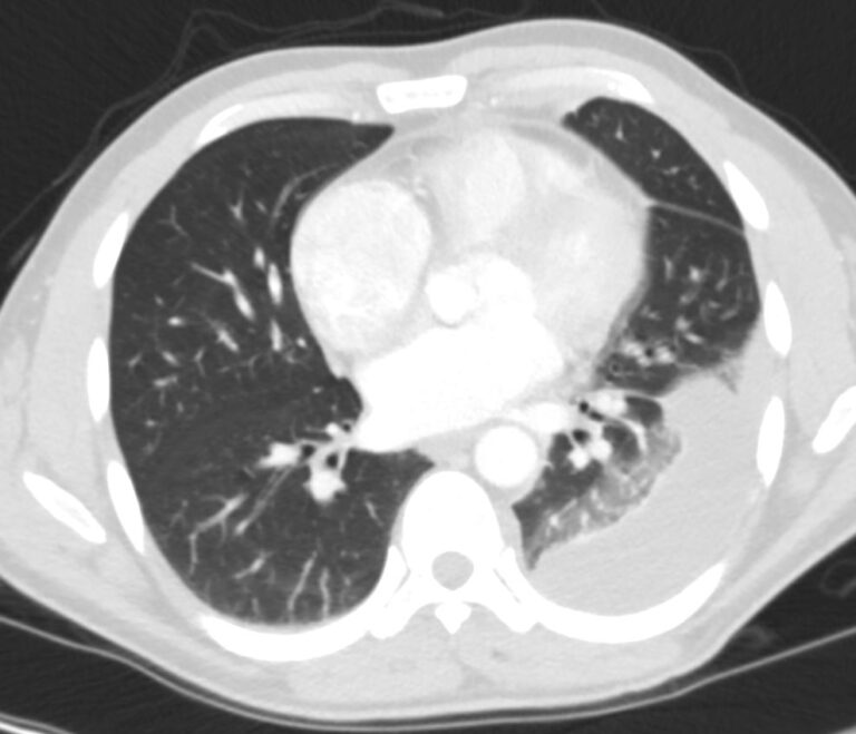 Atelectasis Compressive 